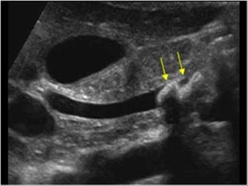 Hình ảnh sỏi ống mật chủ trên siêu âm
