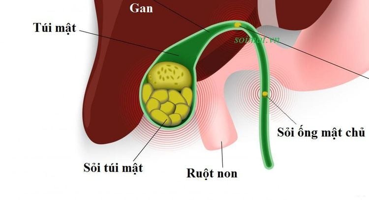 Hình ảnh sỏi ống mật chủ trên siêu âm