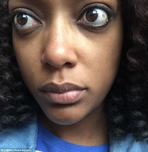 Trong cường giáp do bệnh Basedow, người bệnh có thể bị lồi mắt