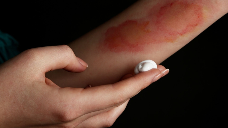 Bị bỏng bôi gì​ và không nên bôi gì để vết thương nhanh lành? 5