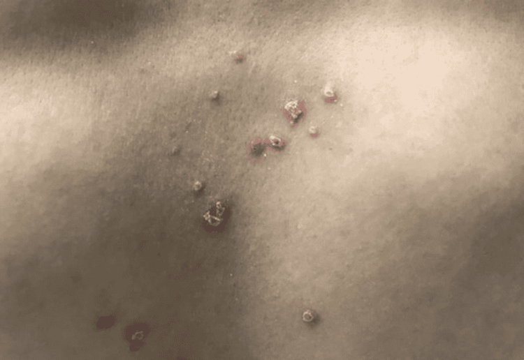 Vì sao da bị ngứa về đêm?