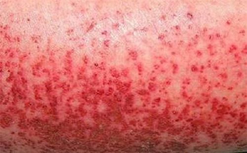 Sốt xuất huyết ở người lớn: Triệu chứng và cách điều trị