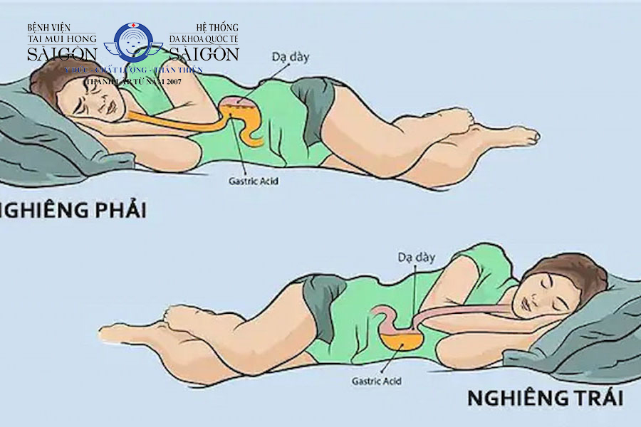Đau dạ dày nên nằm nghiêng