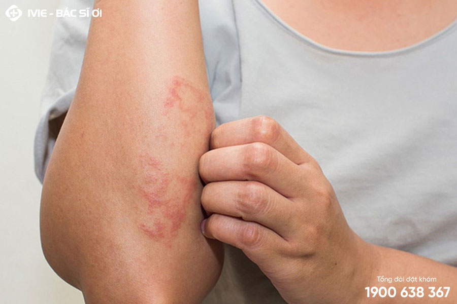 Viêm da tiếp xúc gây đau rát như bị bỏng