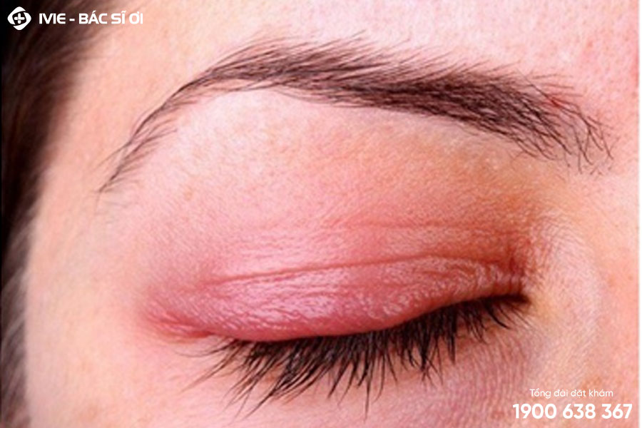 Viêm mí mắt có thể gây nên triệu chứng đau bỏng rát, sưng đỏ, ngứa