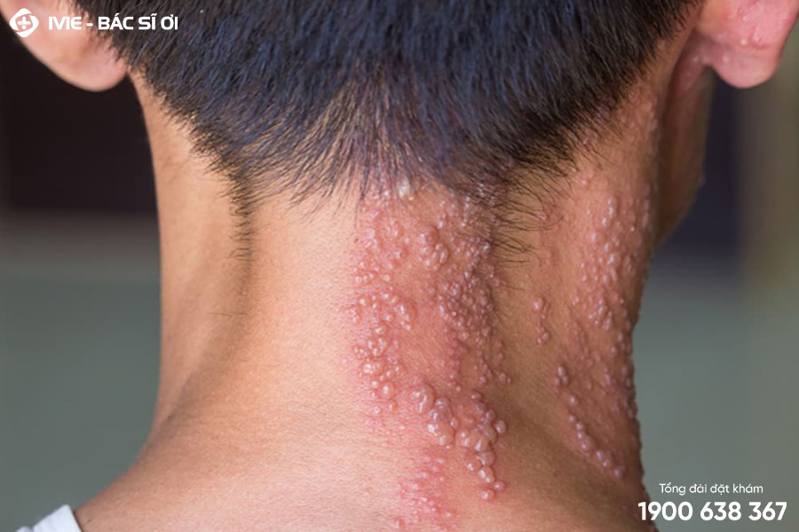 Zona thần kinh gây đau rát