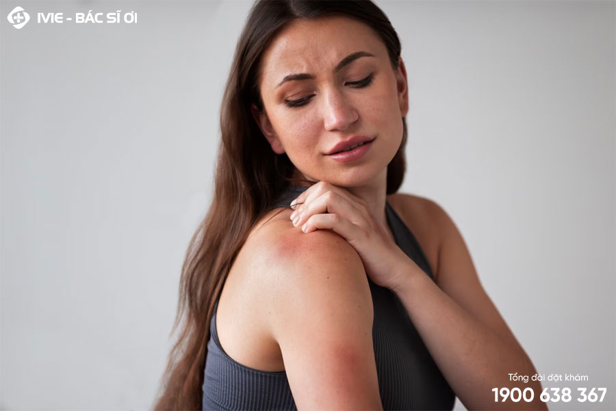 Da đau rát như bị bỏng là bị làm sao? Cách điều trị