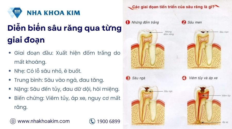 Diễn biến sâu răng qua từng giai đoạn