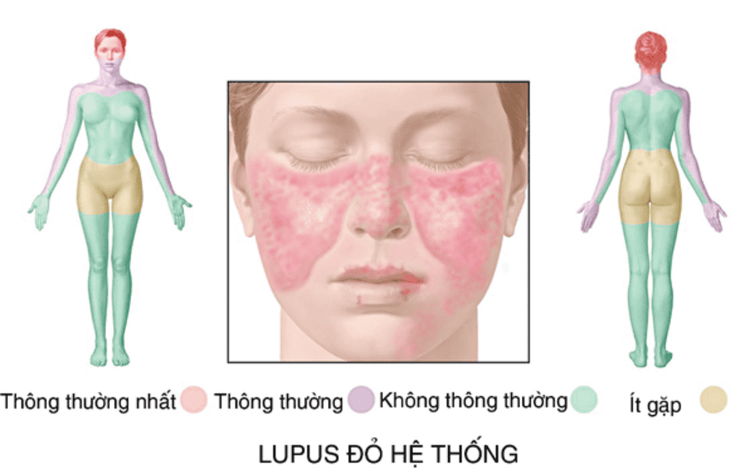 Bệnh lupus ban đỏ hệ thống là gì?