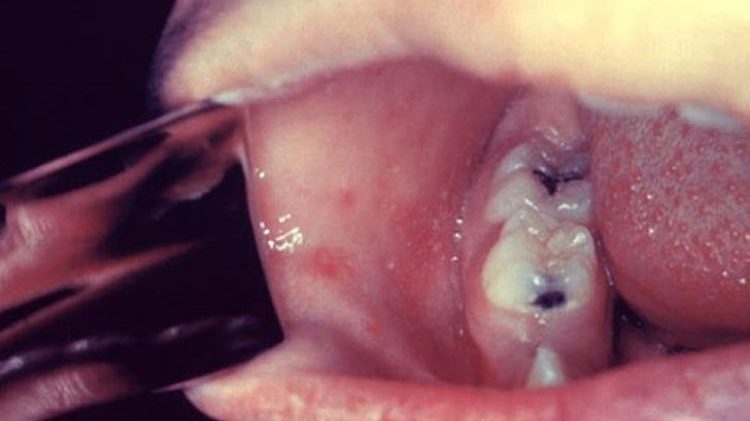 Hạt Koplik - Dấu hiệu đặc trưng bệnh sởi mà ai cũng nên biết 2