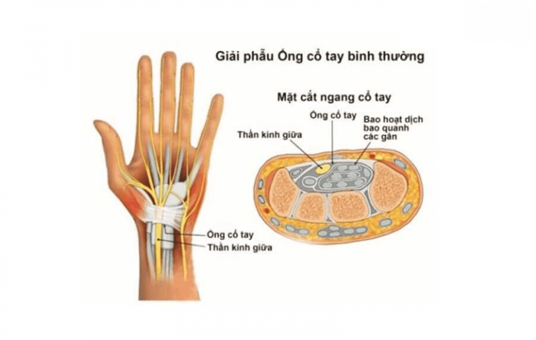 đau cổ tay là bệnh gì