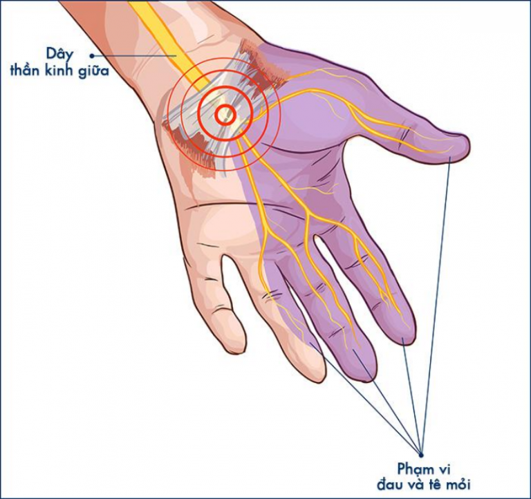 hội chứng ống cổ tay