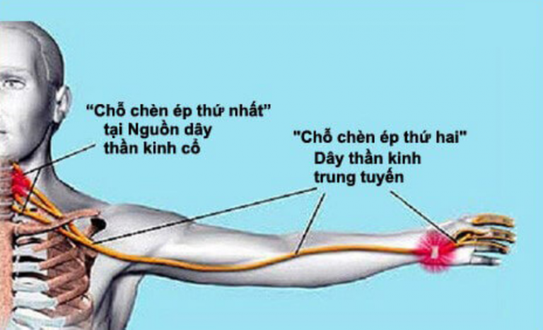 Hội chứng chèn ép đúp