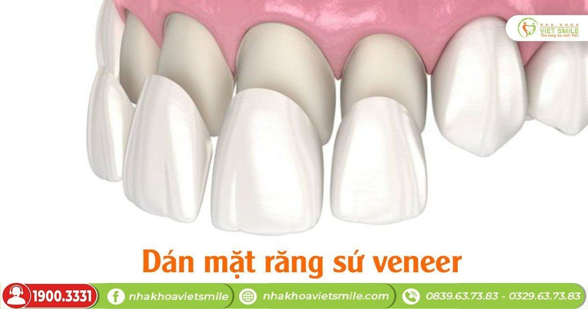 Dán mặt răng sứ veneer