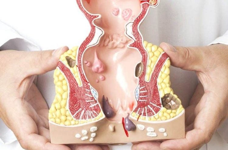 Các nguyên nhân khiến hậu môn bị sưng