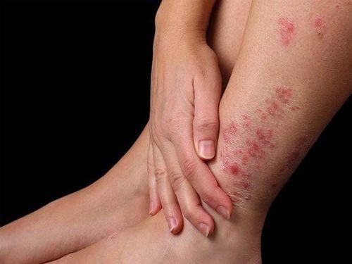 Bệnh nhân có dấu hiệu ngứa vào ban đêm