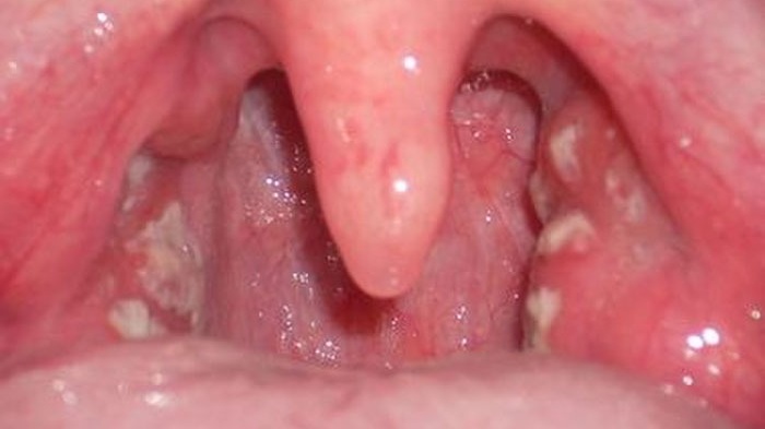 Hình ảnh viêm họng hạt: Nhận diện và phân biệt các triệu chứng hiệu quả 4