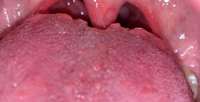 Hình ảnh viêm họng hạt: Nhận diện và phân biệt các triệu chứng hiệu quả 7