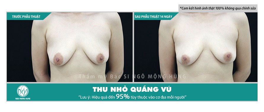 Hình ảnh thu nhỏ quầng vú