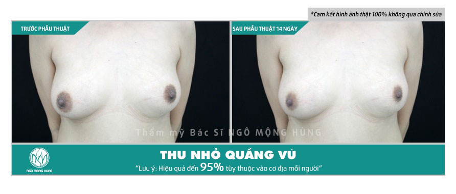 Hình ảnh thu nhỏ quầng vú
