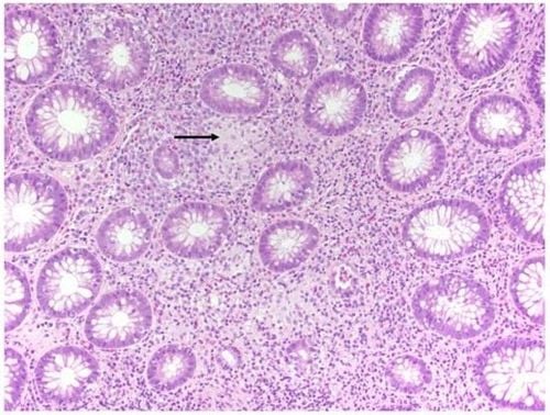 Giải phẫu bệnh cho thấy viêm nang lông và u hạt không hoại tử (mũi tên) ở niêm mạc trực tràng (H&E, 400×).