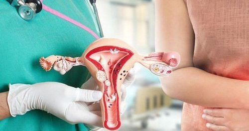 Tìm hiểu về lạc nội mạc trong cơ tử cung