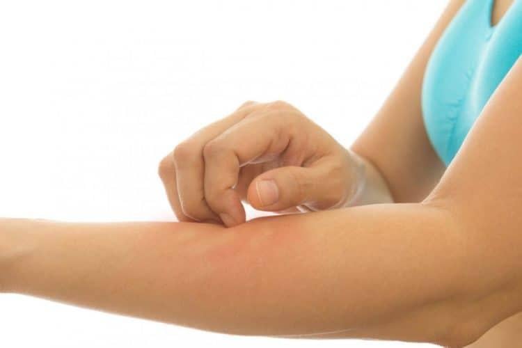 Ngứa nổi mề đay toàn thân: Nguyên nhân và cách điều trị