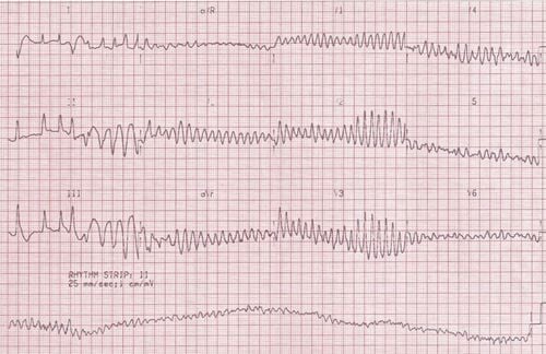 Bệnh nhân cần được kiểm tra kĩ lưỡng để phát hiện và ngăn ngừa bệnh nhịp tim nhanh từ sớm
