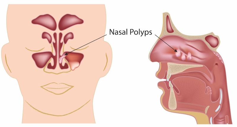 Polyp mũi có tự hết không, có phương pháp nào điều trị?