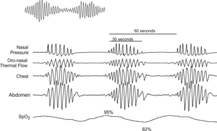 Thở Cheyne - Stokes