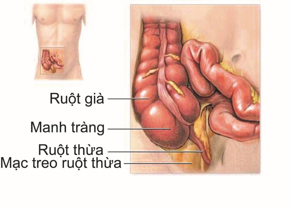 Viêm ruột thừa.