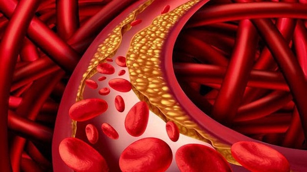 Thuốc chống đột quỵ là những loại thuốc nào? Cần lưu ý gì khi dùng thuốc chống đột quỵ?