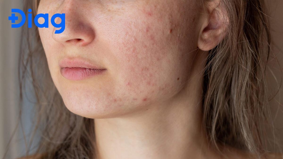 Chậm kinh nếu kèm theo mụn trứng cá thì cần khám bác sĩ sớm.