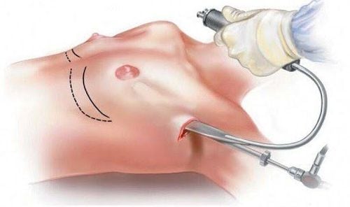 Đường mổ nâng ngực dưới nách sẽ là lựa chọn phù hợp cho chị em