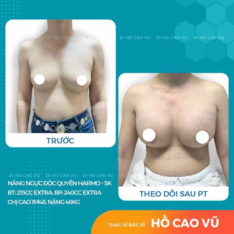 Hình ảnh nâng ngực sau 5 tuần: Túi Extra, hai bên lệch size