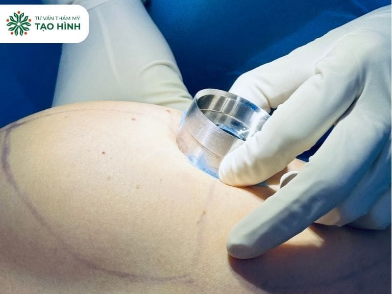 Nâng ngực size to ảnh hưởng tới vòng 1 ra sao? Giải đáp từ bác sĩ