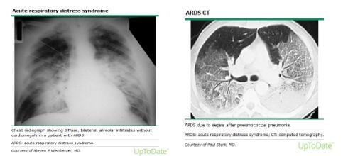 Người mắc bệnh phổi màu trắng có thể gặp biến chứng như hội chứng suy hô hấp cấp tính