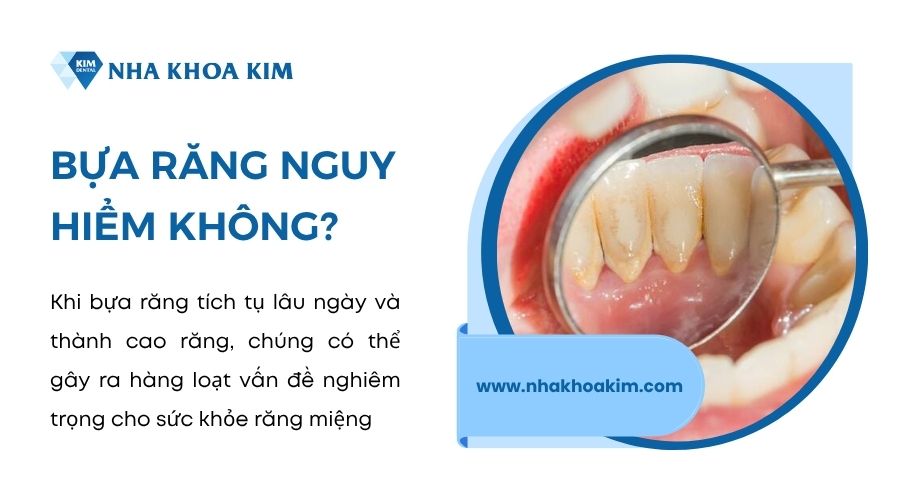 Bựa răng có nguy hiểm không