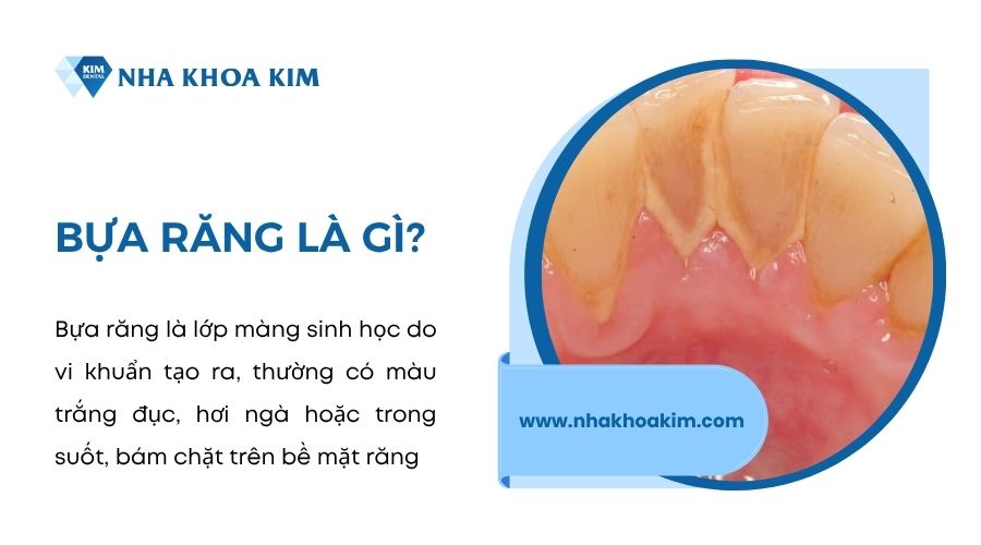 Bựa răng là gì? Nguyên nhân, cách khắc phục