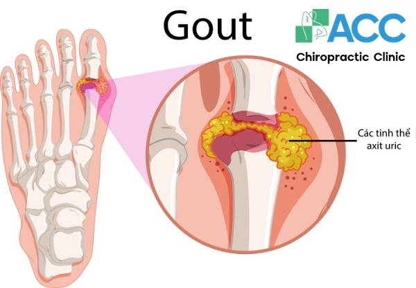 đau bàn chân do bệnh gout