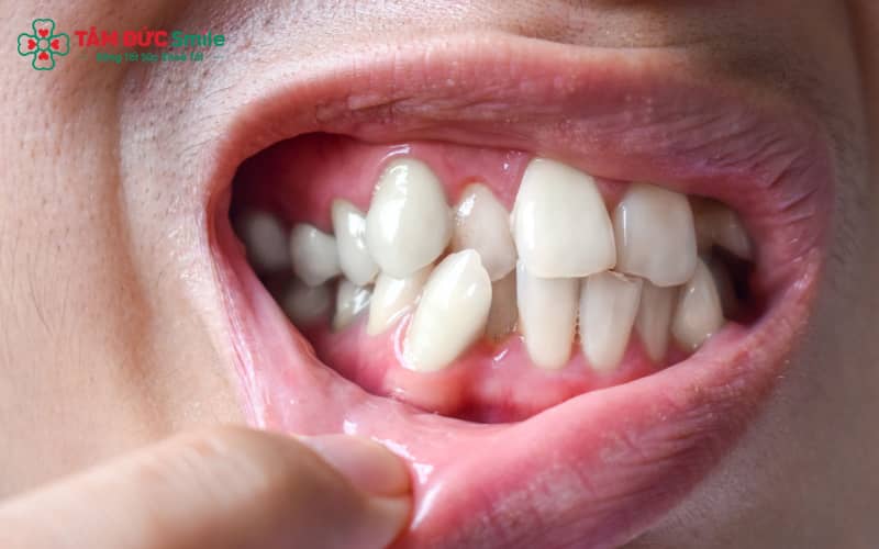 Tình trạng răng chen chúc bắt nguồn từ nhiều yếu tố khác nhau