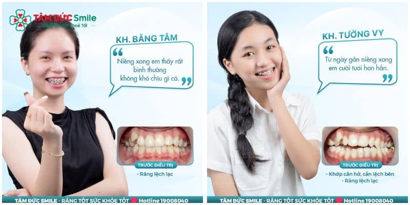 Thời gian chỉnh nha răng chen chúc trung bình kéo dài 18 - 30 tháng