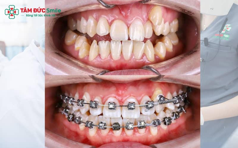 Mắc cài kim loại là lựa chọn phổ biến nhờ hiệu quả rõ rệt và chi phí phải chăng