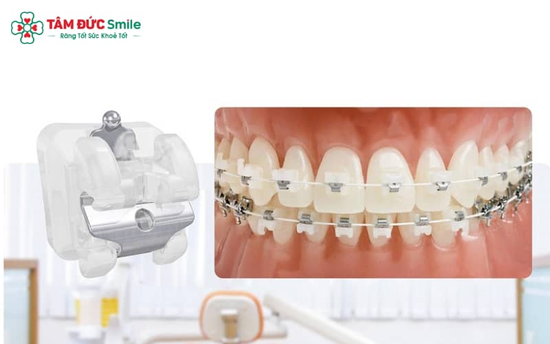 Mắc cài kim loại là lựa chọn phổ biến nhờ hiệu quả rõ rệt và chi phí phải chăng