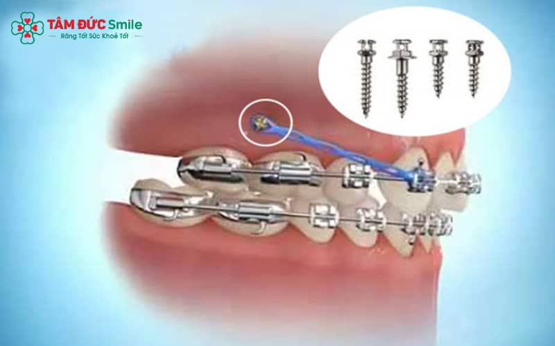 Cắm minivis giải pháp tăng hiệu quả di chuyển răng trong các ca chen chúc phức tạp.