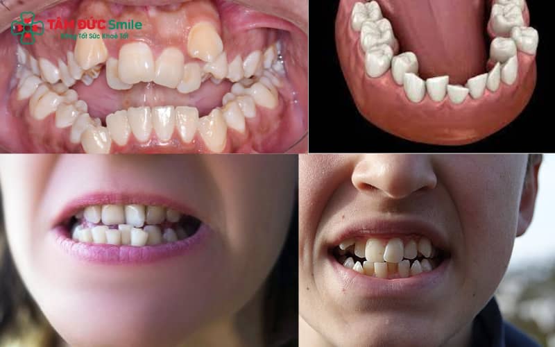 Niềng răng chen chúc – Giải pháp điều trị răng lệch lạc, khấp khểnh, sai khớp cắn