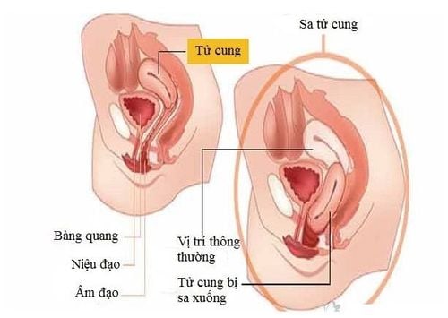 Sa tử cung có thể bắt nguồn từ nhiều nguyên nhân