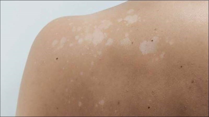 Bài thuốc chữa lang ben kết hợp giữa củ riềng, chút chít và nước cốt chanh