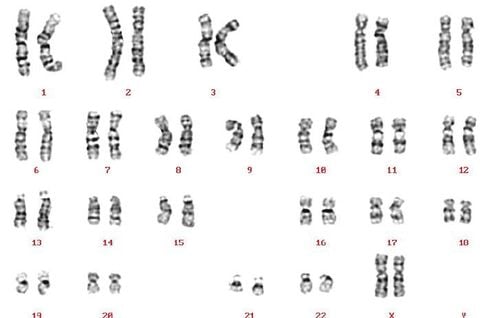 Karyotype bình thường ở nữ giới (Reproduced courtesy of Human Genome Centre, Universiti Sains Malaysia, Malaysia)