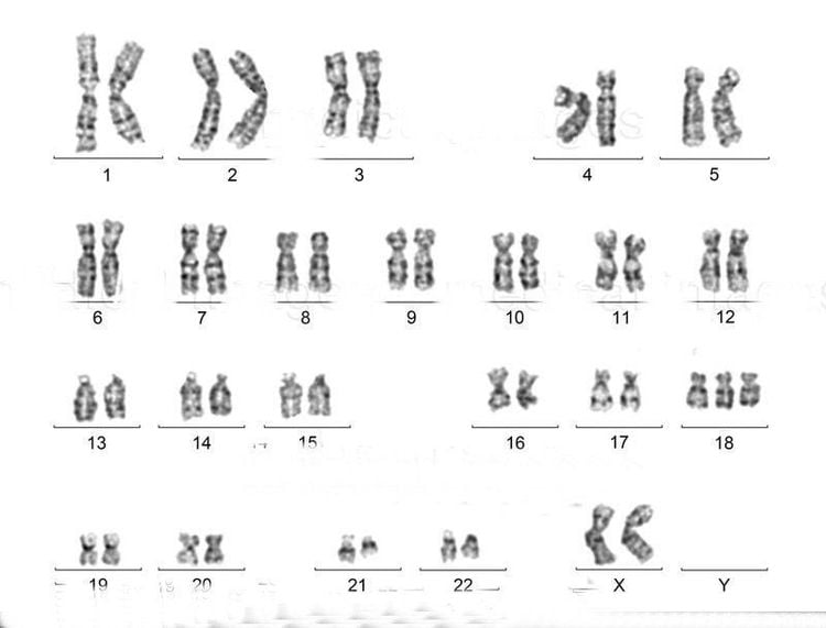 Karyotype bất thường của nữ giới mắc hội chứng Edwards (Trisomy 18) (https://www.medicalimages.com/)